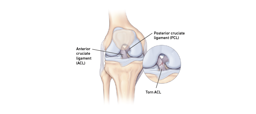 Torn ACL